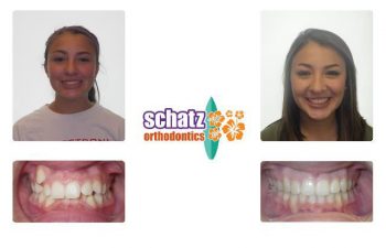 Schatz Orthodontics teen patient : girl's teeth before and after orthodontic treatment