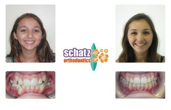Schatz Orthodontics teen patient : girl's teeth before and after orthodontic treatment