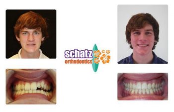 Schatz Orthodontics teen patient : young man's teeth before and after orthodontic treatment