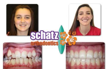 Schatz Orthodontics teen patient : girl's teeth before and after orthodontic treatment