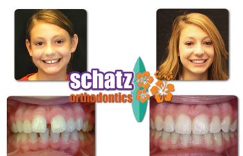 Schatz Orthodontics teen patient : girl's teeth before and after orthodontic treatment