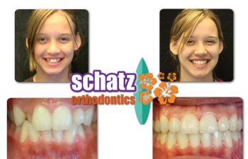 Schatz Orthodontics teen patient : girl's teeth before and after orthodontic treatment