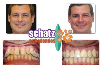 Schatz Orthodontics adult patient : man's teeth before and after orthodontic treatment