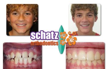Schatz Orthodontics teen patient : boy's teeth before and after orthodontic treatment